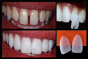 Lente de Contato Dentária