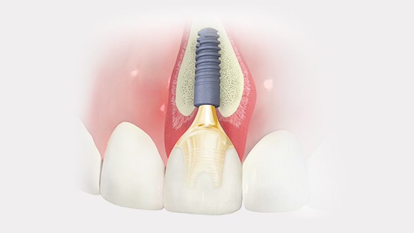Implantes Dentários