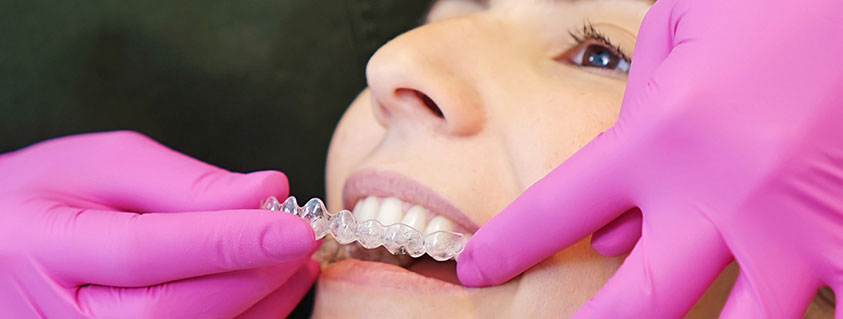 INVISALIGN - ALINHADOR INVISÍVEL DENTAL
