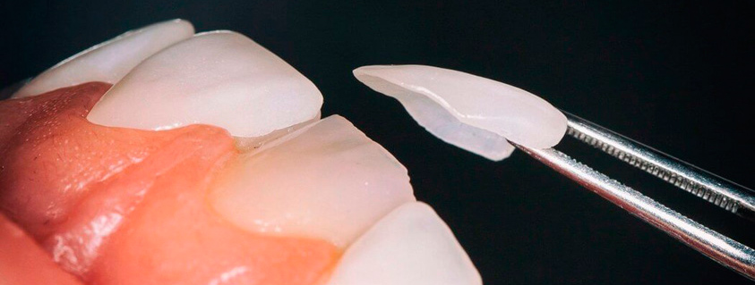LENTE DE CONTATO DENTÁRIA EM APENAS 2 SESSÕES NO DENTISTA!